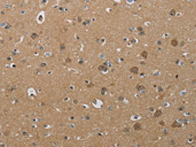 The image on the left is immunohistochemistry of paraffin-embedded Human brain tissue using CSB-PA304185(PHKG2 Antibody) at dilution 1/30, on the right is treated with synthetic peptide. (Original magnification: ×200)