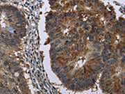 The image on the left is immunohistochemistry of paraffin-embedded Human colon cancer tissue using CSB-PA304268(HSD17B6 Antibody) at dilution 1/20, on the right is treated with fusion protein. (Original magnification: ×200)