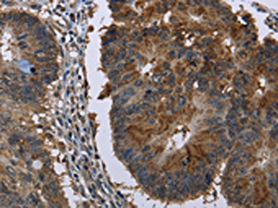 The image on the left is immunohistochemistry of paraffin-embedded Human colon cancer tissue using CSB-PA304268(HSD17B6 Antibody) at dilution 1/20, on the right is treated with fusion protein. (Original magnification: ×200)