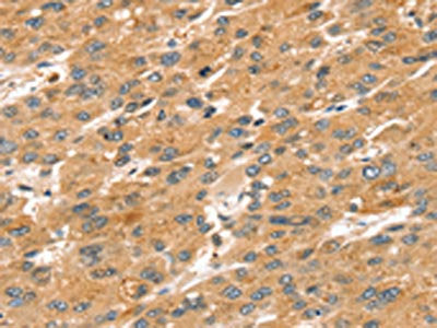 The image on the left is immunohistochemistry of paraffin-embedded Human liver cancer tissue using CSB-PA308950(SPATA18 Antibody) at dilution 1/20, on the right is treated with synthetic peptide. (Original magnification: ×200)