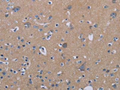The image on the left is immunohistochemistry of paraffin-embedded Human brain tissue using CSB-PA309418(PDE4D Antibody) at dilution 1/20, on the right is treated with synthetic peptide. (Original magnification: ×200)