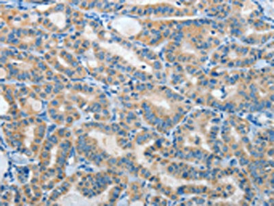 The image on the left is immunohistochemistry of paraffin-embedded Human thyroid cancer tissue using CSB-PA313276(IL21R Antibody) at dilution 1/40, on the right is treated with fusion protein. (Original magnification: ×200)