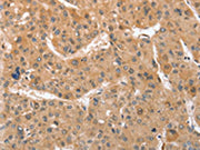 The image on the left is immunohistochemistry of paraffin-embedded Human liver cancer tissue using CSB-PA313566(ATG12 Antibody) at dilution 1/70, on the right is treated with fusion protein. (Original magnification: ×200)
