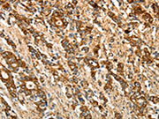 The image on the left is immunohistochemistry of paraffin-embedded Human gastic cancer tissue using CSB-PA314121(CALR Antibody) at dilution 1/50, on the right is treated with fusion protein. (Original magnification: ×200)