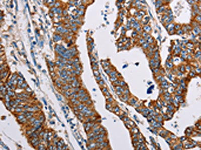 The image on the left is immunohistochemistry of paraffin-embedded Human gastic cancer tissue using CSB-PA314311(ALG2 Antibody) at dilution 1/35, on the right is treated with fusion protein. (Original magnification: ×200)