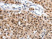 The image on the left is immunohistochemistry of paraffin-embedded Human lung cancer tissue using CSB-PA314476(SUMO1 Antibody) at dilution 1/20, on the right is treated with synthetic peptide. (Original magnification: ×200)