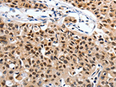 The image on the left is immunohistochemistry of paraffin-embedded Human lung cancer tissue using CSB-PA314476(SUMO1 Antibody) at dilution 1/20, on the right is treated with synthetic peptide. (Original magnification: ×200)