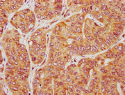 IHC image of CSB-PA314551LA01HU diluted at 1:200 and staining in paraffin-embedded human liver cancer performed on a Leica BondTM system. After dewaxing and hydration, antigen retrieval was mediated by high pressure in a citrate buffer (pH 6.0). S...