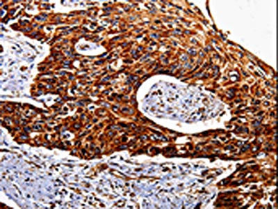 The image is immunohistochemistry of paraffin-embedded Human esophagus cancer tissue using CSB-PA316039(IL17RC Antibody) at dilution 1/20. (Original magnification: ×200)