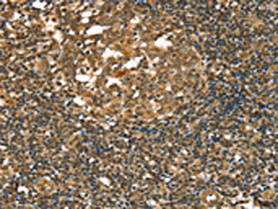 The image on the left is immunohistochemistry of paraffin-embedded Human tonsil tissue using CSB-PA316150(STAB1 Antibody) at dilution 1/20, on the right is treated with synthetic peptide. (Original magnification: ×200)
