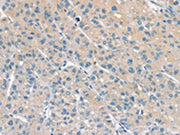 The image on the left is immunohistochemistry of paraffin-embedded Human liver cancer tissue using CSB-PA318216(PPP2CA Antibody) at dilution 1/20, on the right is treated with fusion protein. (Original magnification: ×200)