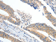 The image on the left is immunohistochemistry of paraffin-embedded Human colon cancer tissue using CSB-PA318254(APOB Antibody) at dilution 1/10, on the right is treated with synthetic peptide. (Original magnification: ×200)