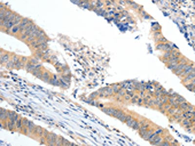 The image on the left is immunohistochemistry of paraffin-embedded Human colon cancer tissue using CSB-PA318254(APOB Antibody) at dilution 1/10, on the right is treated with synthetic peptide. (Original magnification: ×200)