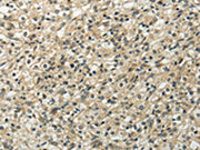 The image on the left is immunohistochemistry of paraffin-embedded Human prostate cancer tissue using CSB-PA318833(UBL4B Antibody) at dilution 1/20, on the right is treated with fusion protein. (Original magnification: ×200)