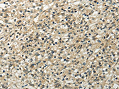 The image on the left is immunohistochemistry of paraffin-embedded Human prostate cancer tissue using CSB-PA318833(UBL4B Antibody) at dilution 1/20, on the right is treated with fusion protein. (Original magnification: ×200)