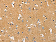 The image on the left is immunohistochemistry of paraffin-embedded Human brain tissue using CSB-PA319466(DNM3 Antibody) at dilution 1/20, on the right is treated with fusion protein. (Original magnification: ×200)