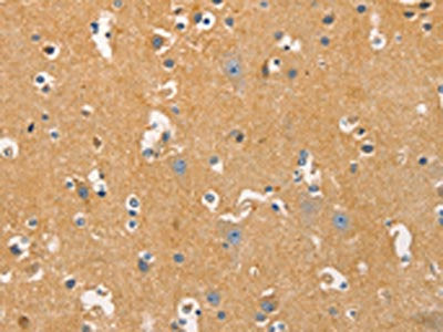 The image on the left is immunohistochemistry of paraffin-embedded Human brain tissue using CSB-PA319466(DNM3 Antibody) at dilution 1/20, on the right is treated with fusion protein. (Original magnification: ×200)