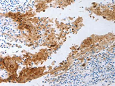 The image on the left is immunohistochemistry of paraffin-embedded Human tonsil tissue using CSB-PA319979(NGFR Antibody) at dilution 1/30, on the right is treated with synthetic peptide. (Original magnification: ×200)