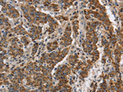 The image on the left is immunohistochemistry of paraffin-embedded Human liver cancer tissue using CSB-PA320879(KCNQ4 Antibody) at dilution 1/40, on the right is treated with synthetic peptide. (Original magnification: ×200)