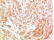 Immunohistochemical analysis of paraffin-embedded Human Breast Carcinoma Tissue using ERK1 Rabbit pAb diluted at 1:500
