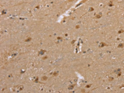 The image on the left is immunohistochemistry of paraffin-embedded Human brain tissue using CSB-PA324006(DLD Antibody) at dilution 1/35, on the right is treated with fusion protein. (Original magnification: ×200)