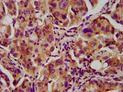 IHC image of CSB-PA324989LA01HU diluted at 1:600 and staining in paraffin-embedded human lung cancer performed on a Leica BondTM system. After dewaxing and hydration, antigen retrieval was mediated by high pressure in a citrate buffer (pH 6.0). Se...