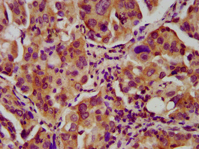 IHC image of CSB-PA324989LA01HU diluted at 1:600 and staining in paraffin-embedded human lung cancer performed on a Leica BondTM system. After dewaxing and hydration, antigen retrieval was mediated by high pressure in a citrate buffer (pH 6.0). Se...