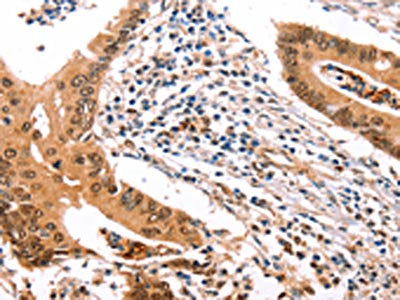 The image on the left is immunohistochemistry of paraffin-embedded Human colon cancer tissue using CSB-PA325213(ERBB3 Antibody) at dilution 1/35, on the right is treated with fusion protein. (Original magnification: ×200)