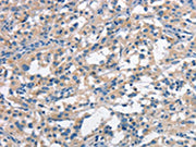 The image on the left is immunohistochemistry of paraffin-embedded Human thyroid cancer tissue using CSB-PA325565(ANAPC1 Antibody) at dilution 1/30, on the right is treated with synthetic peptide. (Original magnification: ×200)