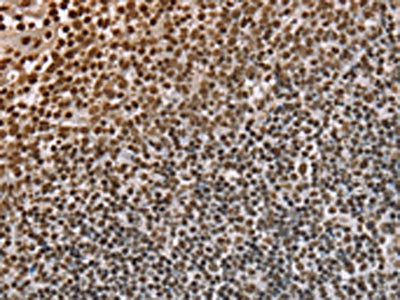 The image on the left is immunohistochemistry of paraffin-embedded Human tonsil tissue using CSB-PA325589(NUP50 Antibody) at dilution 1/30, on the right is treated with fusion protein. (Original magnification: ×200)