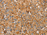 The image on the left is immunohistochemistry of paraffin-embedded Human liver cancer tissue using CSB-PA326406(SSBP1 Antibody) at dilution 1/30, on the right is treated with fusion protein. (Original magnification: ×200)