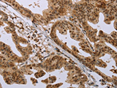 The image on the left is immunohistochemistry of paraffin-embedded Human gastic cancer tissue using CSB-PA327117(CFLAR Antibody) at dilution 1/20, on the right is treated with synthetic peptide. (Original magnification: ×200)