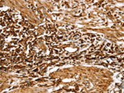 The image on the left is immunohistochemistry of paraffin-embedded Human gastic cancer tissue using CSB-PA327160(RPLP1 Antibody) at dilution 1/25, on the right is treated with fusion protein. (Original magnification: ×200)