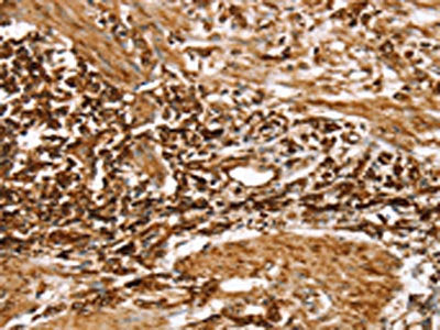 The image on the left is immunohistochemistry of paraffin-embedded Human gastic cancer tissue using CSB-PA327160(RPLP1 Antibody) at dilution 1/25, on the right is treated with fusion protein. (Original magnification: ×200)