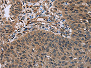 The image on the left is immunohistochemistry of paraffin-embedded Human lung cancer tissue using CSB-PA327528(HOMER1 Antibody) at dilution 1/50, on the right is treated with fusion protein. (Original magnification: ×200)