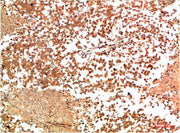 Immunohistochemical analysis of paraffin-embedded Human Lung Carcinoma Tissue using HSP90α Rabbit pAb diluted at 1:200