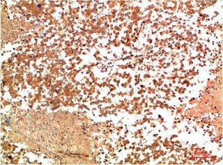 Immunohistochemical analysis of paraffin-embedded Human Lung Carcinoma Tissue using HSP90α Rabbit pAb diluted at 1:200