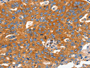 The image on the left is immunohistochemistry of paraffin-embedded Human ovarian cancer tissue using CSB-PA332497(CAP2 Antibody) at dilution 1/60, on the right is treated with fusion protein. (Original magnification: ×200)