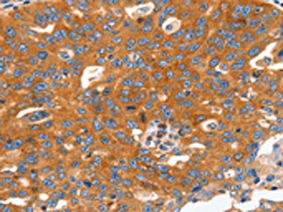 The image on the left is immunohistochemistry of paraffin-embedded Human ovarian cancer tissue using CSB-PA332497(CAP2 Antibody) at dilution 1/60, on the right is treated with fusion protein. (Original magnification: ×200)