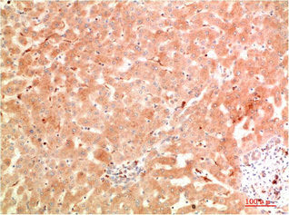 Immunohistochemical analysis of paraffin-embedded Human Hepatocarcinoma Tissue using ATG5 Rabbit pAb diluted at 1:200