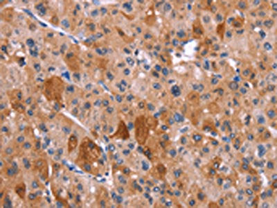 The image on the left is immunohistochemistry of paraffin-embedded Human liver cancer tissue using CSB-PA334654(HRH1 Antibody) at dilution 1/40, on the right is treated with synthetic peptide. (Original magnification: ×200)