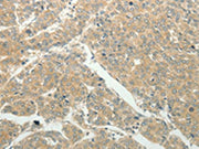 The image on the left is immunohistochemistry of paraffin-embedded Human liver cancer tissue using CSB-PA335714(SLC8A3 Antibody) at dilution 1/50, on the right is treated with synthetic peptide. (Original magnification: ×200)