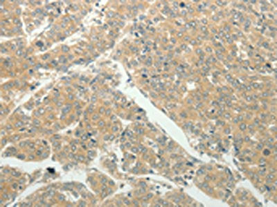 The image on the left is immunohistochemistry of paraffin-embedded Human liver cancer tissue using CSB-PA335714(SLC8A3 Antibody) at dilution 1/50, on the right is treated with synthetic peptide. (Original magnification: ×200)