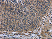 The image on the left is immunohistochemistry of paraffin-embedded Human lung cancer tissue using CSB-PA335882(AVEN Antibody) at dilution 1/30, on the right is treated with synthetic peptide. (Original magnification: ×200)