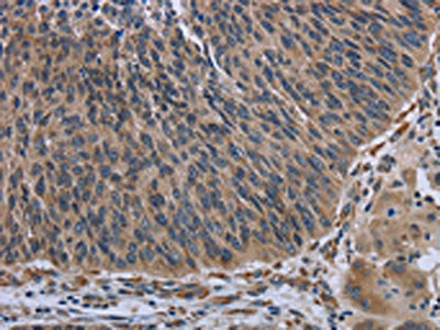 The image on the left is immunohistochemistry of paraffin-embedded Human lung cancer tissue using CSB-PA335882(AVEN Antibody) at dilution 1/30, on the right is treated with synthetic peptide. (Original magnification: ×200)