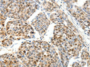 The image on the left is immunohistochemistry of paraffin-embedded Human ovarian cancer tissue using CSB-PA336738(SCTR Antibody) at dilution 1/25, on the right is treated with synthetic peptide. (Original magnification: ×200)