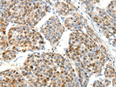 The image on the left is immunohistochemistry of paraffin-embedded Human ovarian cancer tissue using CSB-PA336738(SCTR Antibody) at dilution 1/25, on the right is treated with synthetic peptide. (Original magnification: ×200)