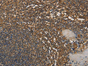 The image on the left is immunohistochemistry of paraffin-embedded Human tonsil tissue using CSB-PA337435(DAB2 Antibody) at dilution 1/25, on the right is treated with fusion protein. (Original magnification: ×200)