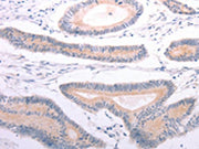 The image on the left is immunohistochemistry of paraffin-embedded Human colon cancer tissue using CSB-PA337817(ANGPTL2 Antibody) at dilution 1/20, on the right is treated with synthetic peptide. (Original magnification: ×200)