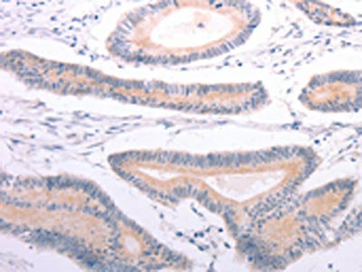 The image on the left is immunohistochemistry of paraffin-embedded Human colon cancer tissue using CSB-PA337817(ANGPTL2 Antibody) at dilution 1/20, on the right is treated with synthetic peptide. (Original magnification: ×200)